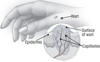 Struktura brodawki na dłoni